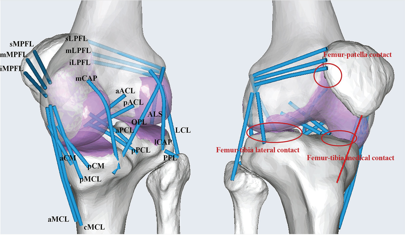 Fig. 1 
            Schematic of the knee model with contact conditions and 21 ligament bundle: The aACL and pACL; aPCL and pPCL; anterolateral structures; LCL; popliteofibular ligament PFL; medial collateral ligament (aMCL, cMCL, and pMCL); deep medial collateral ligament (aCM and pCM); medial and lateral posterior capsules (mCAP and lCAP, respectively); oblique popliteal ligament; medial patellofemoral ligament (sMPFL, mMPFL, and iMPFL); and lateral patellofemoral ligament (sLPFL, mLPFL, and iLPFL).
          