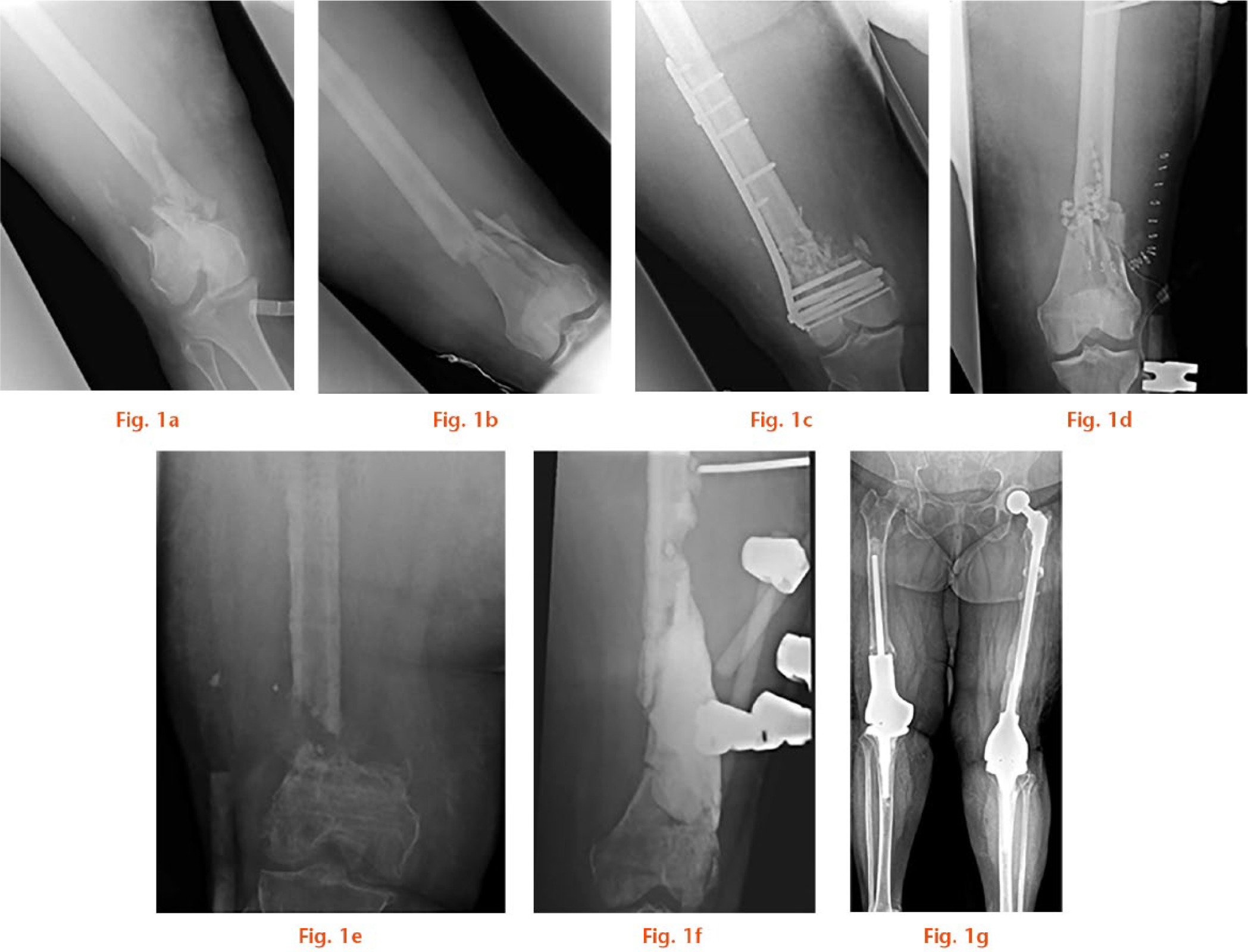  
          Radiological time course of 59-year-old female patient after bilateral open distal femoral fractures (a, c, e: right leg; b, d, f: left leg). a) and b) radiographs at admission with bilateral femoral comminuted fractures. Of note is the bone deficiency on the right femur immediately after injury. c) and d) The status after initial stabilization. Note the shortening and comminution of the right distal femur and the gentamicin beads in the femoral canal of the left femur indicating post-traumatic infection therapy. e) Images after removal of the plate and external stabilization of the right femur. Note the atrophic nonunion, indicating biological inhibition of bone healing. f) Radiographs after removal of avital femoral bone and temporary replacement with antibiotic-loaded bone cement of the left femur. g) Latest radiograph of the follow-up showing both knees replaced with distal femoral replacements; on the left limb, a total femoral replacement was necessary due to the too small residuum of the femur after resecting all infected and dead bone.
        