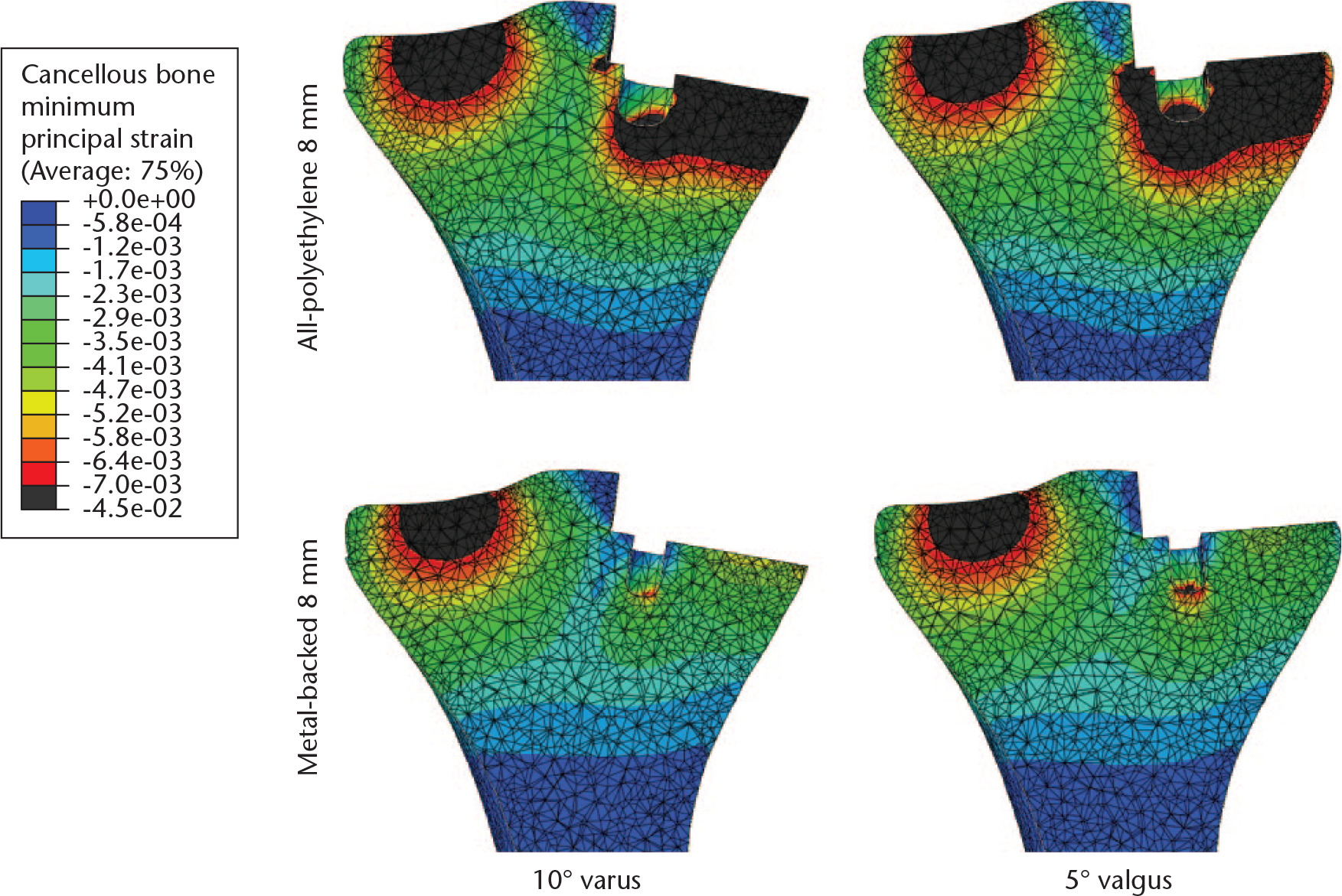 Fig. 4 
            Mid-coronal plane contour maps showing for all-polyethylene and metal-backed implants in varus and valgus malalignment at a medial load of 2500 N.
          