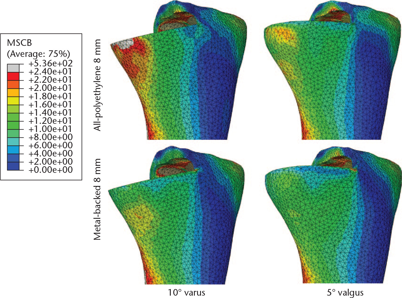 Fig. 5 
            Anteromedial contour maps showing von Mises stress in cortical bone (MSCB) for all-polyethylene and metal-backed implants in varus and valgus malalignment at a medial load of 2500 N.
          