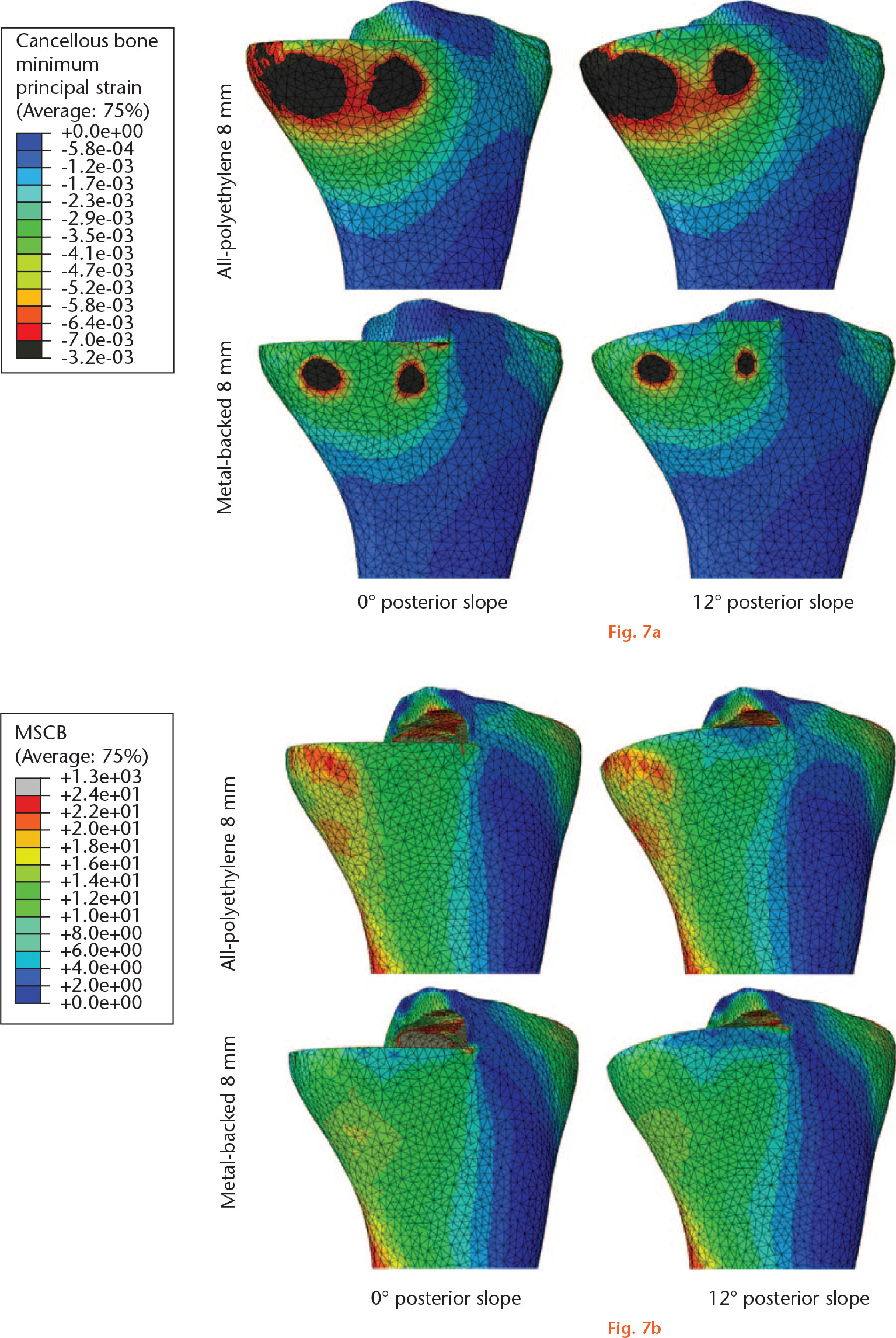  
            a) Cancellous bone minimum principal strain and b) von Mises stress in cortical bone (MSCB) contours for all-polyethylene and metal-backed implants in different sagittal alignments.
          