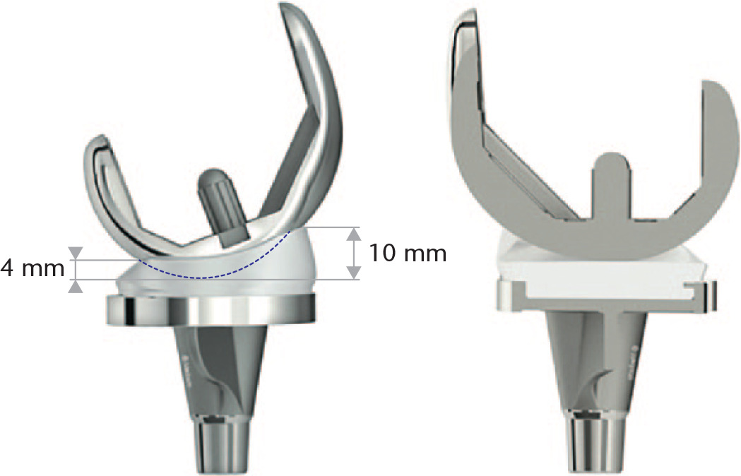 Fig. 1 
          The GMK Sphere prosthesis incorporates a spherical medial tibiofemoral articulation (left) to provide anteroposterior stability over the 0° to 100° flexion arc, and a sagitally flat and coronally partially conforming lateral tibial surface to permit longitudinal rotation (right).
        