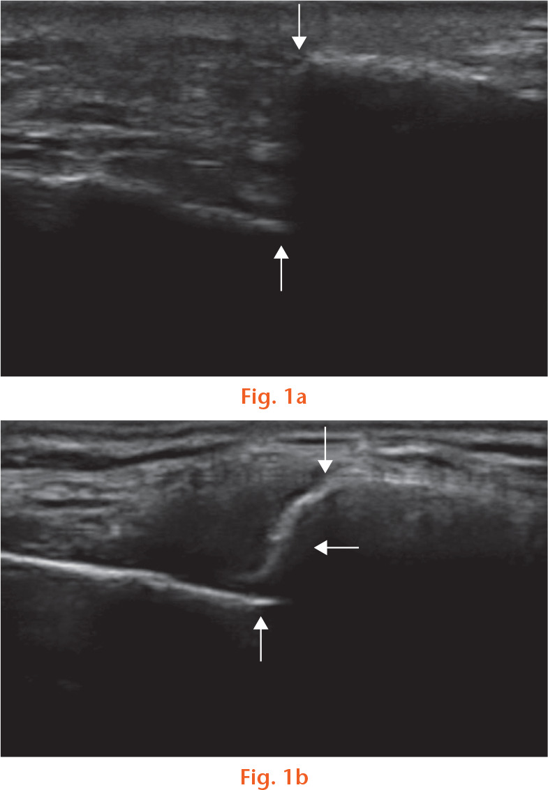 Fig. 1 
            Ultrasound of two patients with a displaced clavicle fracture. a) Nonunion: vertical arrows show end of each fracture fragment with absence of bridging callus at six weeks (symptomatic nonunion confirmed at six months on CT scan). b) Union: vertical arrows show the end of each fracture fragment; the horizontal arrow shows bridging callus at six weeks with a restored cortical bridge.
          