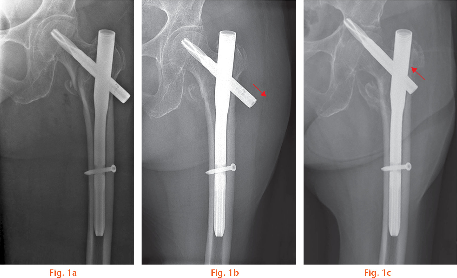 Fig. 1 
          Plain radiographs following fixation of the pertrochanteric left femur fracture with a cephalomedullary device (Proximal Femur Antirotation Nail (PFNA; Synthes, Oberdorf, Switzerland)). a) Immediately postoperative; b) subsequent impaction of the fracture with gradual lateral migration of the femoral neck element with respect to the intramedullary nail component (arrow); c) medial migration of the Femoral Neck Element (FNE) with respect to the intramedullary nail component with perforation of the femoral head and penetration of the acetabulum (arrow).
        