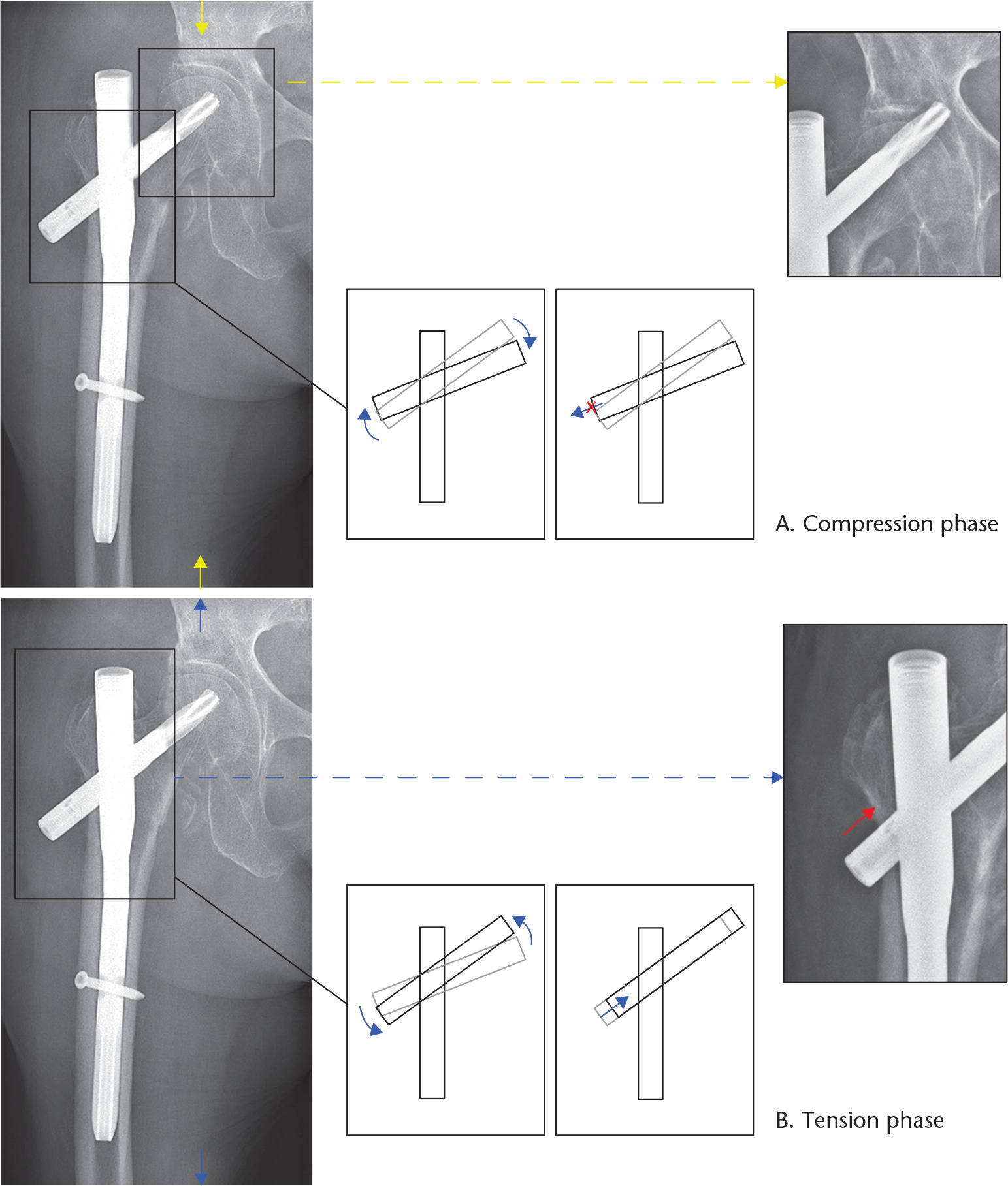 Fig. 10 
          Diagrammatic representation of postulated mechanism behind the medial migration phenomenon with repeated loading-unloading at the hip joint.
        