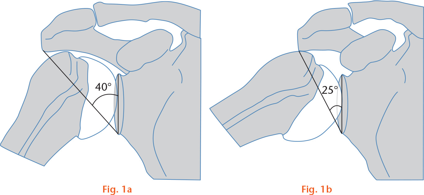 Fig. 1 
          Illustration of hypothesized abduction range of different shoulders: a) high critical shoulder angle (CSA) may limit abduction due to early impingement; b) low CSA may allow greater abduction before impingement.
        