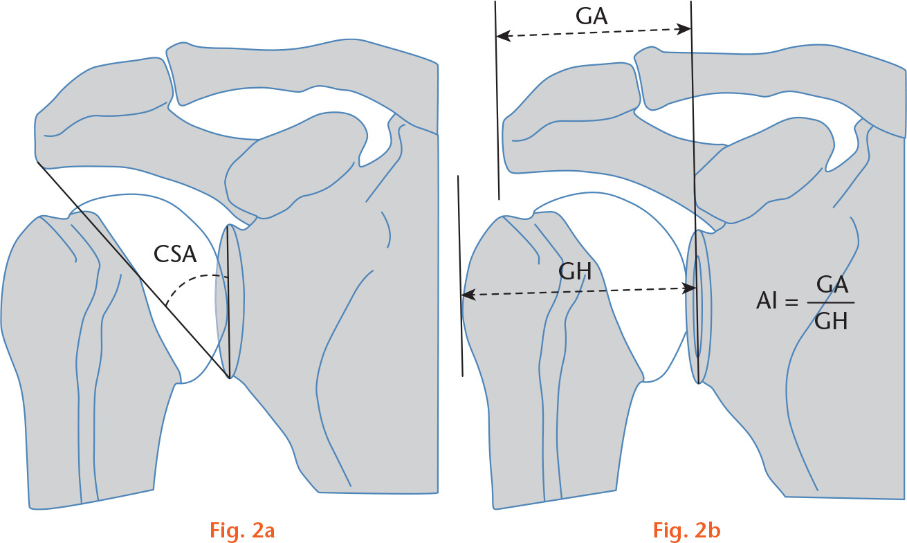Fig. 2 
          Illustrations of a) critical shoulder angle (CSA), and b) acromial index (AI). GA, distance from the glenoid plane to the most lateral aspect of the acromion; GH, distance from the glenoid plane to the most lateral aspect of the proximal humeral head.
        