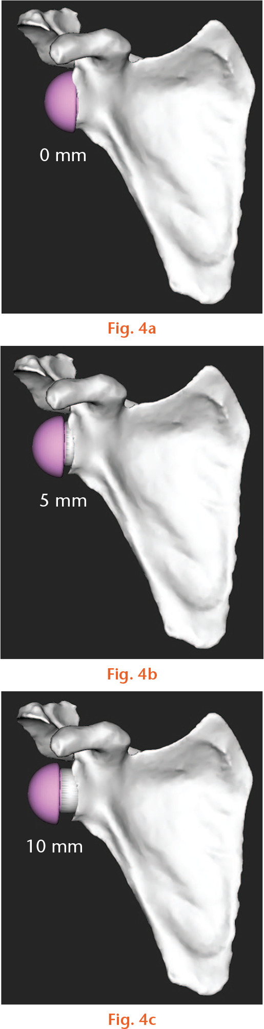 Fig. 4 
            The three glenoid lateralizations evaluated: a) 0 mm; b) 5 mm; and c) 10 mm.
          