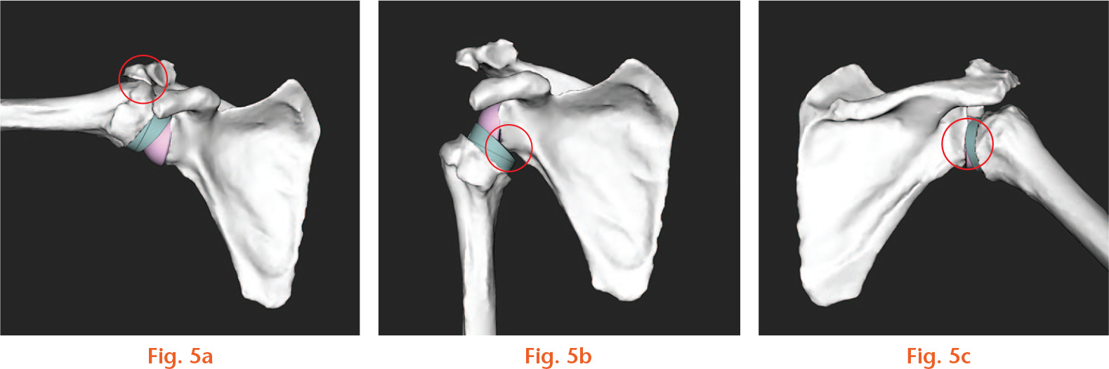 Fig. 5 
            Type of impingements: a) abutment between the greater tuberosity and the acromion at maximal abduction; b) polyethylene contact with the scapular pillar (inferior notching) occurring at internal rotation; and c) impingement between the polyethylene and the posterior glenoid during external rotation with abduction.
          
