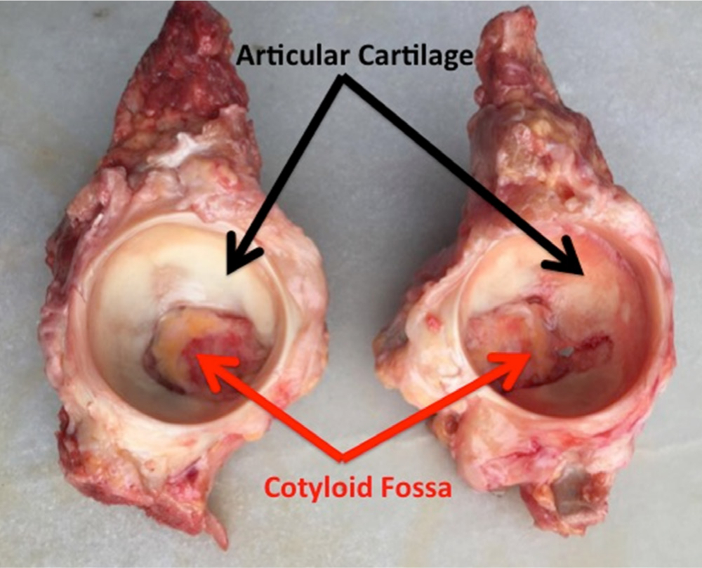 Fig. 2 
            Cadaver model of the acetabulum demonstrating different shapes of acetabular fossa and articular cartilage.
          