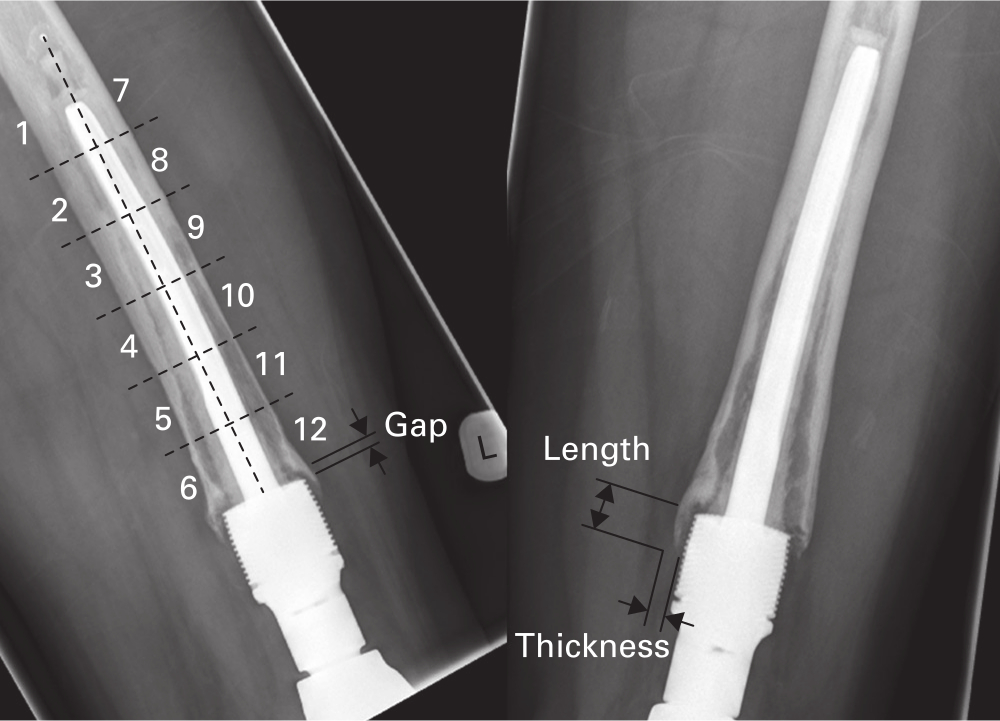 Fig. 2 
            Anteroposterior (right) and lateral (left) radiographs of distal femoral arthroplasty intramedullary component showing the zones used for the radiolucent line score together with length, thickness, and gap distances measured around the hydroxyapatite (HA) collar. Radiolucent lines are evident in all zones in the lateral radiograph, giving a maximum score of 12.
          