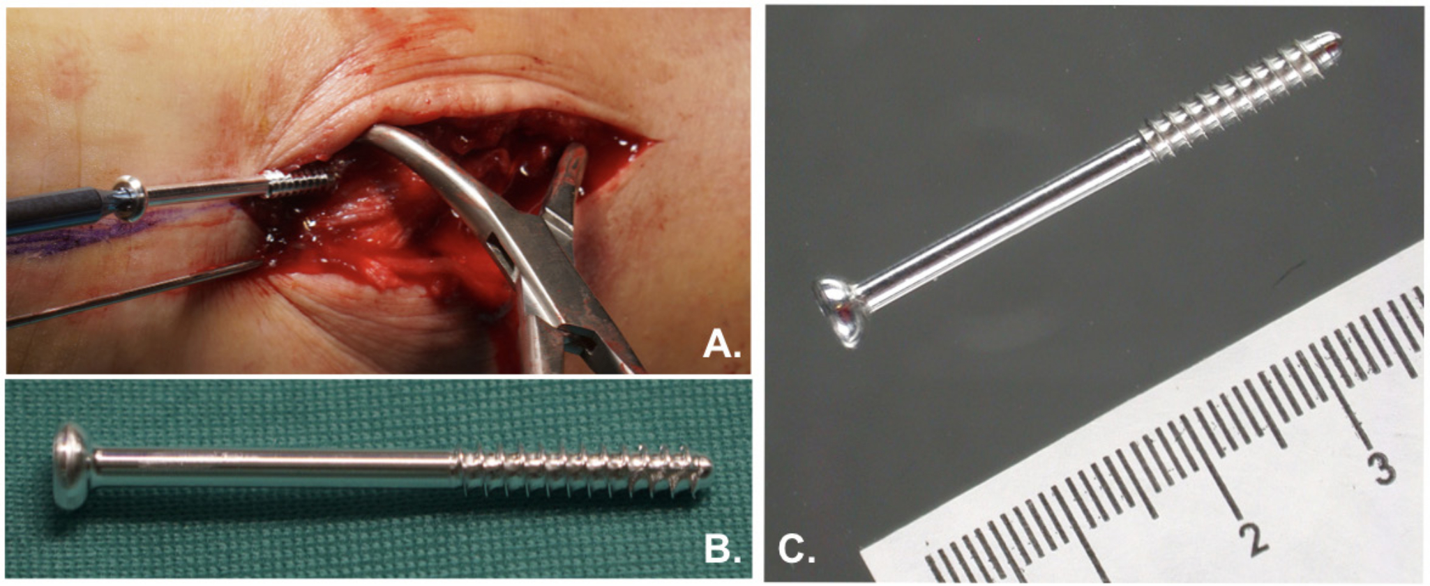 Fig. 1 
            a) Placement of a ZX00 screw in the medial malleolar during surgery. b) and c) External appearance of ZX00 screw.
          