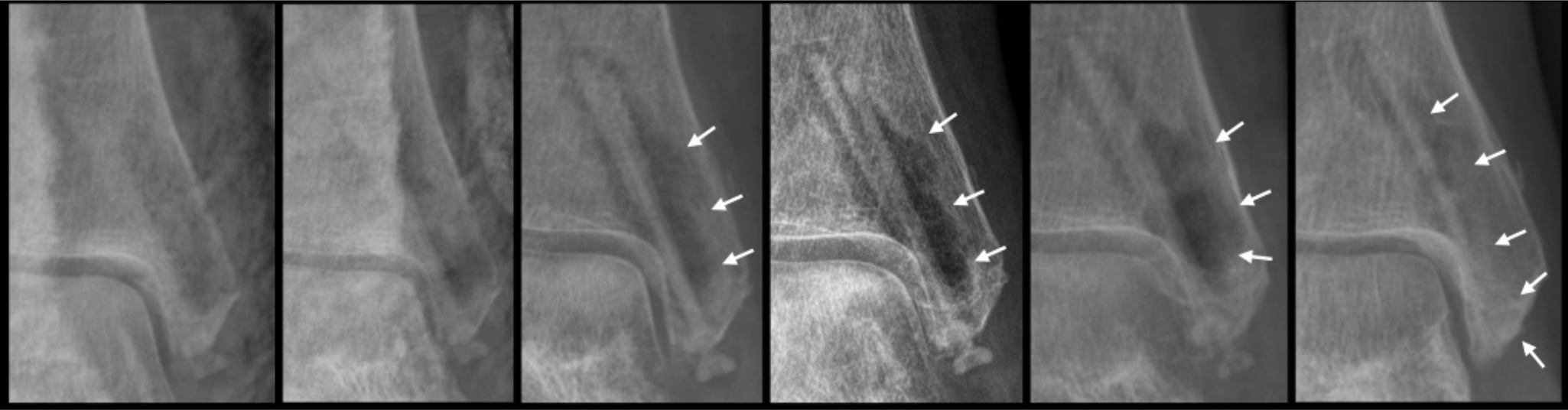 Fig. 4 
            Anteroposterior ankle radiographs of a 61-year-old female patient with pre-existing osteoporosis, bimalleolar fracture with a posterior malleolar fragment. From left to right, anteroposterior ankle radiograph after surgery, after two weeks (reduction of the fractures with two magnesium (Mg)-based screws and a titanium plate and screws), after six weeks (obvious radiolucent zones fracture consolidation), after 12 weeks (steady radiolucency, small sclerotic line at the border of the radiolucent zone to the surrounding tissue), after 24 weeks, and after 52 weeks (steady sclerotic line, increase in density at former radiolucent area). The white arrows show the gas formation arround the screw.
          