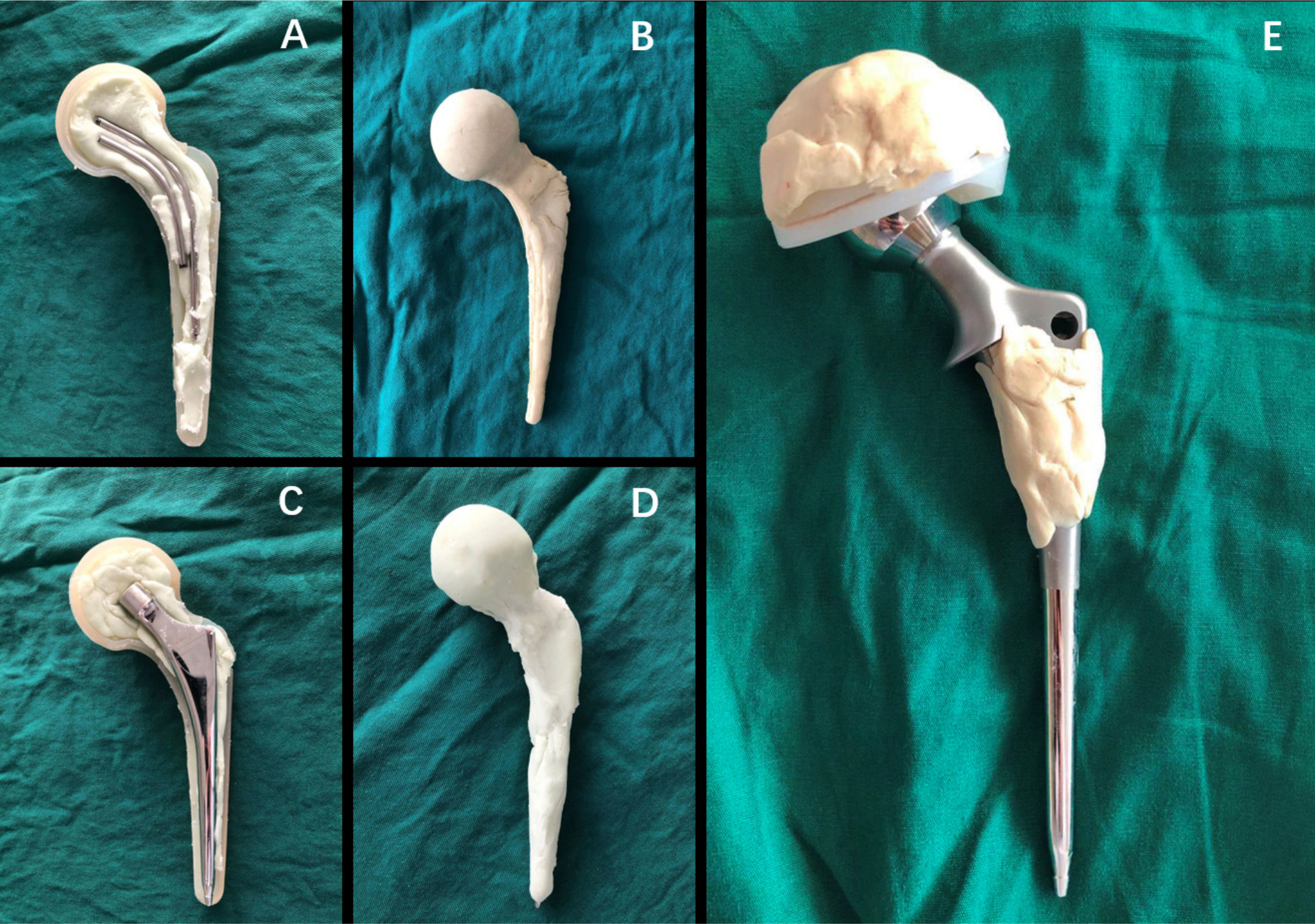 Fig. 1 
             a) and b) Intraoperative photograph showing the coating of two Kirschner-wires with antibiotic cement in group I. c) and d) Intraoperative photograph showing the coating of a small size femoral prosthesis with antibiotic cement in group II. e) Intraoperative photograph of the cemented prosthesis prepared and ready for insertion in group III.
          