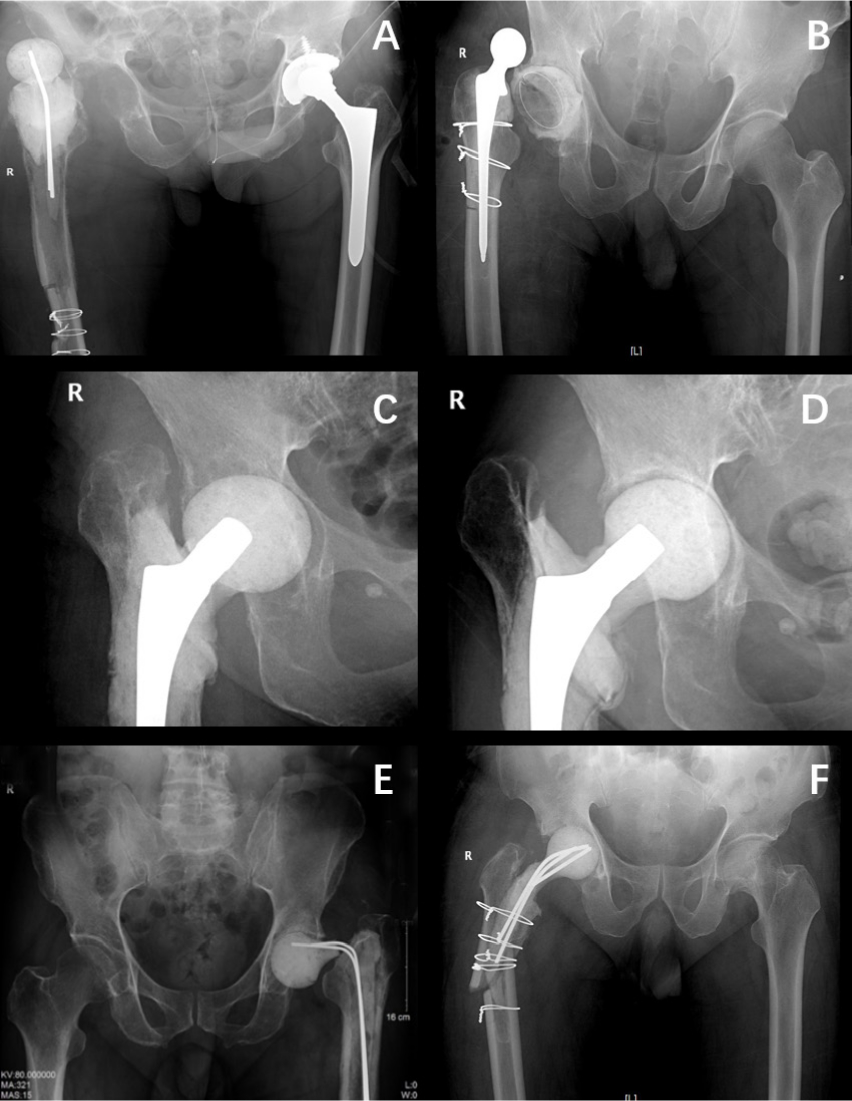 Fig. 3 
            Spacer-related mechanical complications. a) Dislocation of a spacer using Kirschner-wires (K-wires) as endoskeleton in group I. b) Dislocation of a spacer using cemented prosthesis as spacer in group III. c) and d) Acetabular bone wear of a spacer using a small prosthesis as endoskeleton in group II; a 58 mm cup and #7 femoral stem were used in second-stage surgery. e) Fracture of spacers using K-wires as endoskeleton in group I. f) Periarticular fracture of a spacer using K-wires as endoskeleton in group I.
          