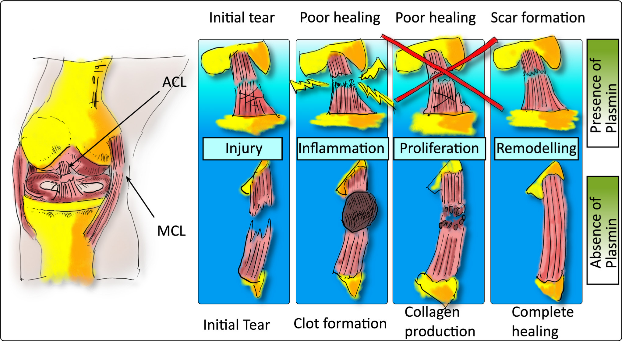 Fig. 1 
          Diagram of the difference in the healing process of the anterior cruciate ligament (ACL) inside the joint capsule filled with synovial fluid compared to the medial collateral ligament (MCL), which is located outside of the joint capsule, thus lacking contact with synovial fluid, which contains plasmin to some extent. The original hypothesis was formulated by Kiapour and Murray3 and has been redrawn here to illustrate the principle.
        