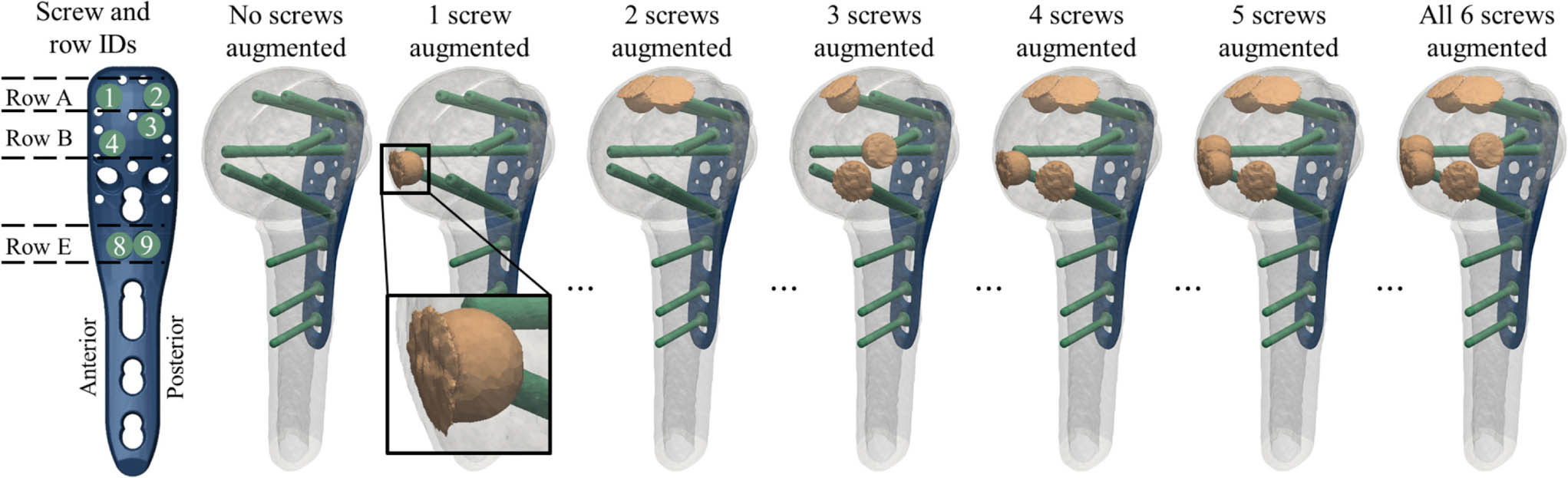 Fig. 1 
            Definition of the screw IDs and row IDs of the proximal humerus internal locking system (PHILOS) plate and anatomical orientation for left humeri (far left); and illustration of the fracture model with transparent fragments to show the virtual instrumentation, for exemplary configurations of zero to six augmented screws (left to right). Note that there were a total of 64 configurations for each subject. A close-up view of a cemented cloud is shown for the case of one augmented screw, demonstrating redistribution of cement material at the subchondral bone interface.
          