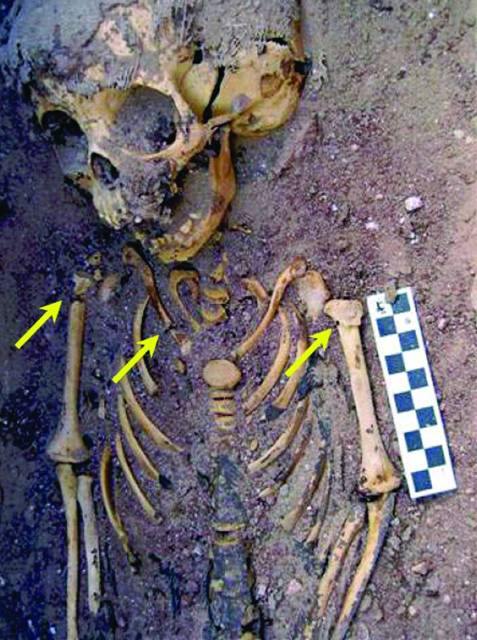 Fig. 10 
          Skeletal injuries in Kellis 2 specimen, strongly suggesting non-accidental injury.
        