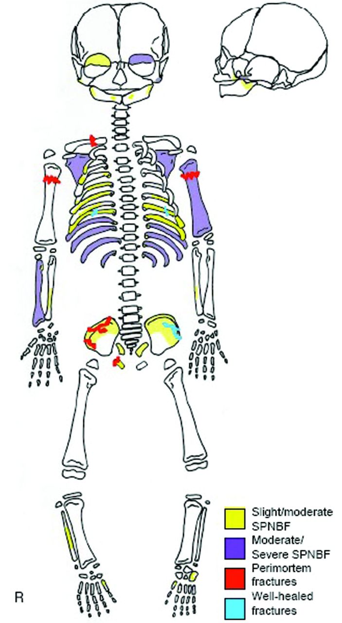 Fig. 11 
          Distribution of skeletal injuries in Kellis 2 specimen, strongly suggesting.
        