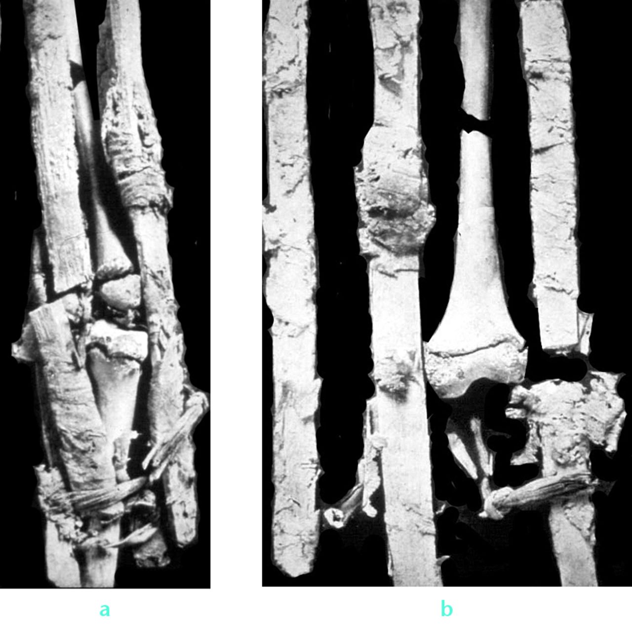 Fig. 2 
          Photographs (a and b) of the earliest known treated human fracture specimen: open femoral fracture of an adolescent (note open physes).
        