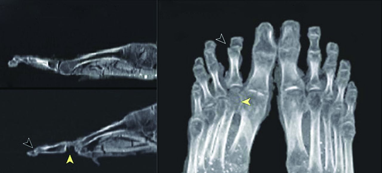 Fig. 7 
          Radiographs of Tutankhamun’s feet, showing osteochondritis of left 2nd metatarsal head.
        