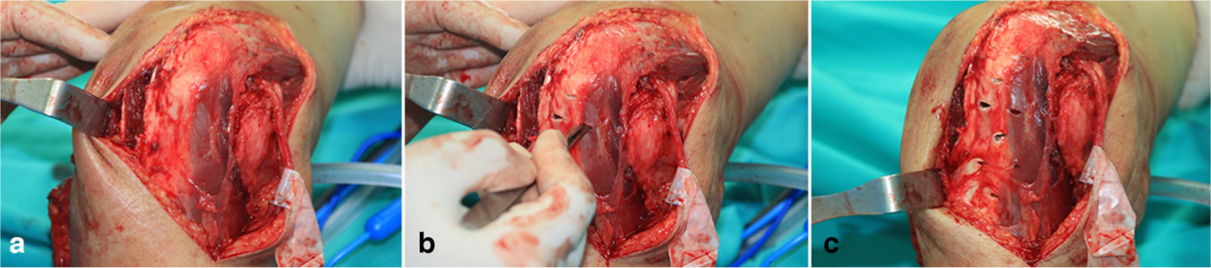 Fig. 1 
            Pie-crusting contracted triceps (tether release). Multiple stab incisions are made in the triceps tendon in the medial-to-lateral and distal-to-proximal directions via the medial approach.
          