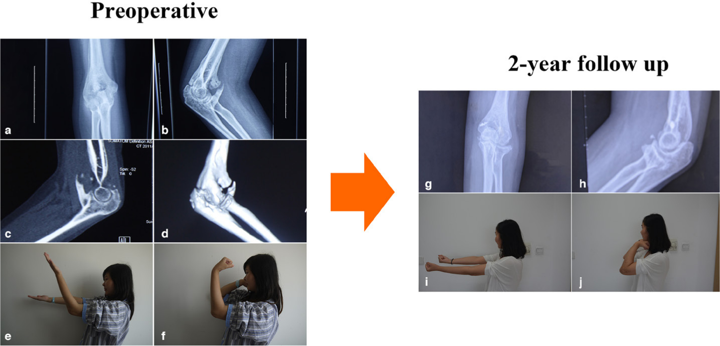 Fig. 4 
            An example of a 37-year-old woman with post-traumatic elbow stiffnes treated with open elbow arthrolysis. a, b) Preoperative radiograph, c) sagittal view of calculated tomography (CT), and d) 3D CT reconstruction showed massive heterotopic ossification around the elbow. Before arthrolysis, the range of movement (ROM) was 35°, with e) extension of 50° and f) flexion of 85°. g, h) Radiographs at two-year follow-up showed no obvious blocks around the elbow, and the ROM recovered to 130°, with i) extension of 0° and j) flexion of 130°.
          