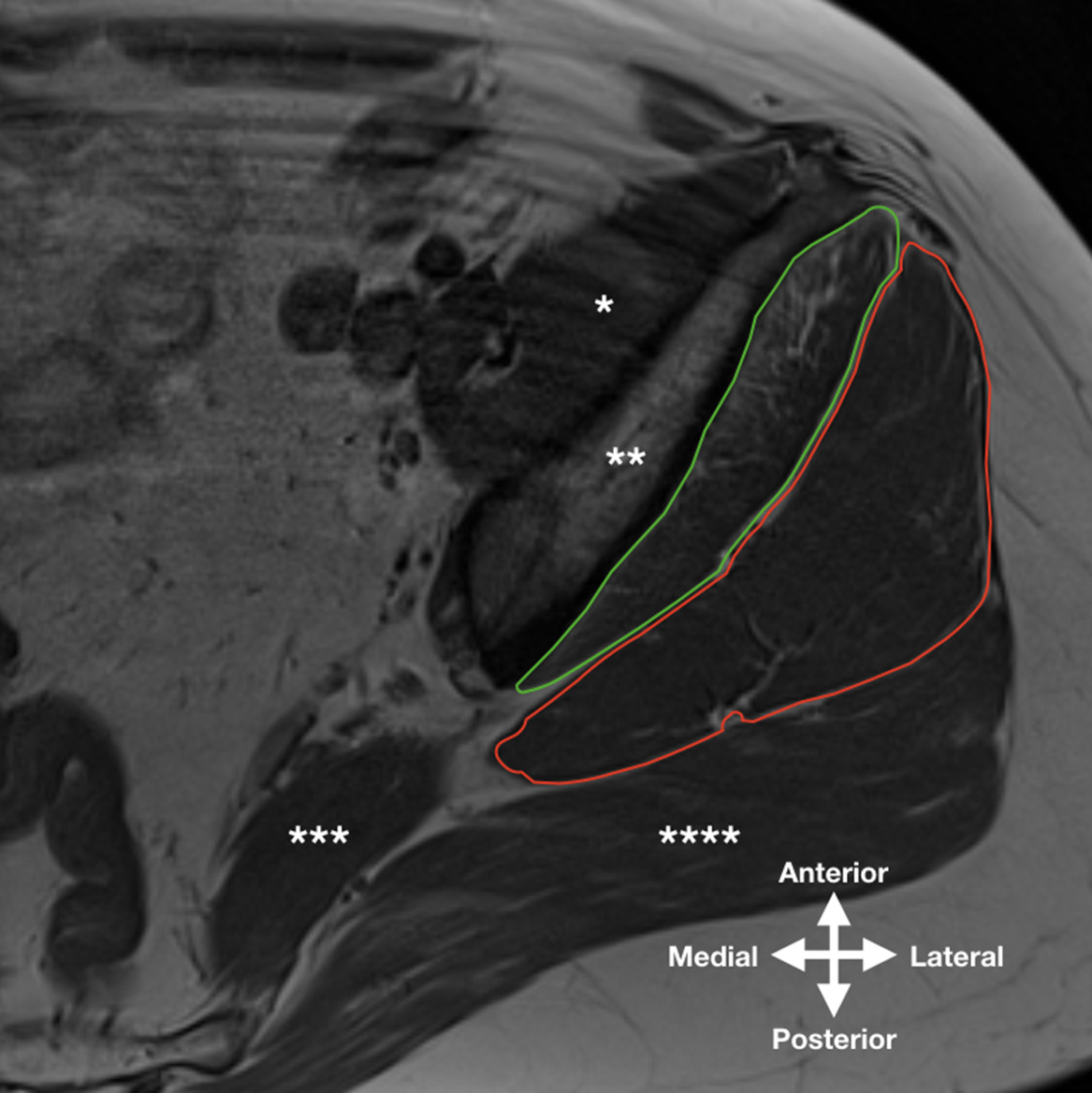 Fig. 1 
            Transverse T1-weighted spin echo image, halfway between the tip of the greater trochanter and the anterior superior iliac spine. Cross-sectional areas of the gluteus minimus (green) and the gluteus medius (red). Other anatomical structures: * Iliacus muscle, ** Ilium, *** Piriformis muscle, **** Gluteus maximus muscle.
          