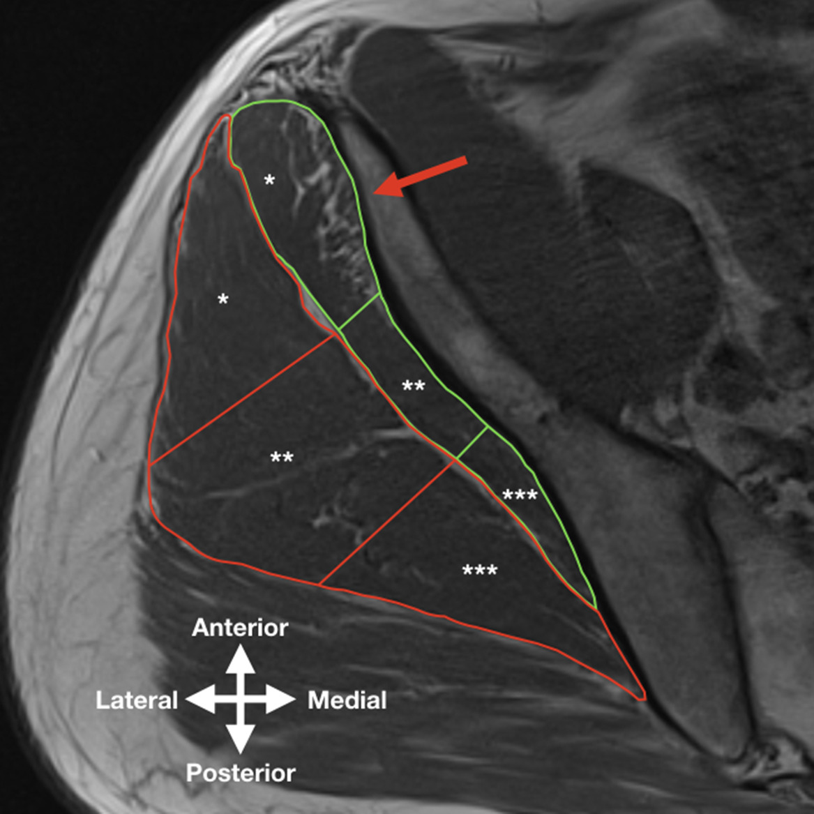 Fig. 2 
            Transverse T1-weighted spin-echo image of the upper part of the gluteal muscles in a healthy control subject. The gluteus minimus (green) and gluteus medius (red) are divided in three equivalent parts: * = anterior part, **= middle part and *** = posterior part. Note the subtle fatty streaks in the anterior part of the gluteus minimus (red arrow). The gluteus medius has normal muscle without fatty infiltration.
          