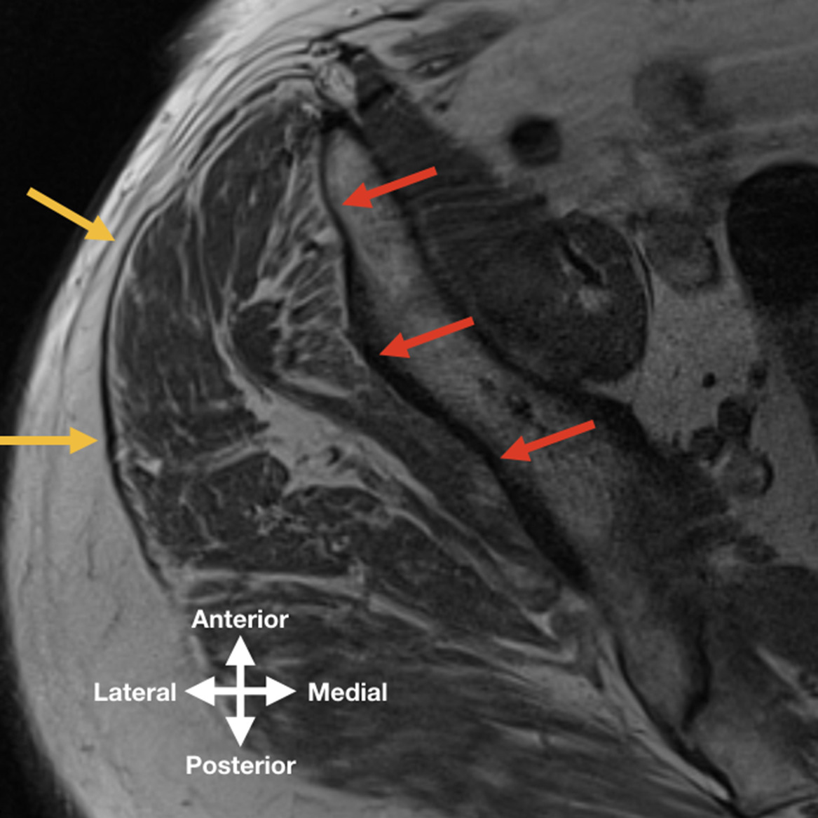 Fig. 7 
            Transverse T1-weighted spin-echo image in an osteoarthritic patient of the gluteus minimus and gluteus medius. Note the moderate fatty infiltration in the anterior and middle part, and subtle fatty streaks in the posterior part of the gluteus minimus (red arrows). The gluteus medius has fatty streaks in the anterior and middle parts (yellow arrows).
          