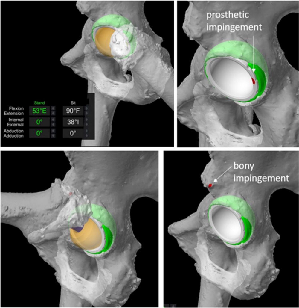 Fig. 2 
          An example where prosthetic impingement is detected in extension during standing (top) and bony impingement was detected during internal rotation at 90° of flexion in the sitting pose (bottom). The femur has been virtually removed in right images for better visualization of impingement.
        