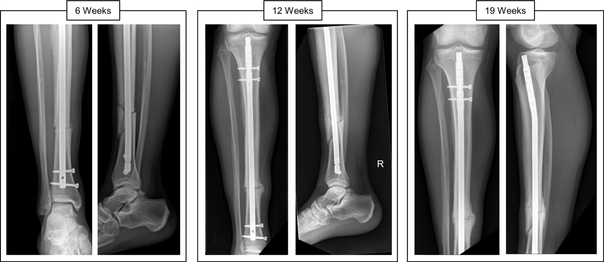 Fig. 3 
          Case example of a micromotion patient with anteroposterior and lateral radiographs shown at six, 12, and 19 weeks. This 25-year-old male with a sports-related closed fracture (closed, OTA/AO 42-B3) reported full return to activity with no pain at 12 weeks.
        