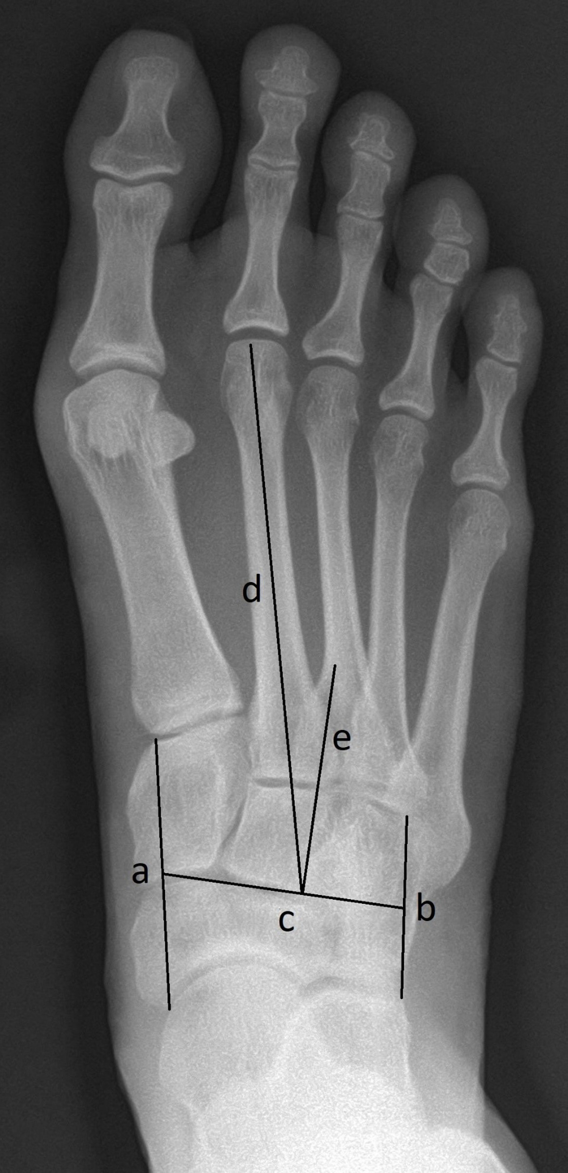 Fig. 1 
          Sgarlato’s metatarsus adductus angle measurement method: Line A extends between the most lateral point of the fourth metatarso-cuboid and the calcaneo-cuboid joints. Line B extends between the most medial point of the talo-navicular and the medial cuneiform-first metatarsal joints. Line C extends between midpoints of lines A and B. Line D represents the longitudinal axis of the second metatarsal bone. Line E is perpendicular to line C and represents the longitudinal axis of the lesser tarsus. Sgarlato's angle is between the lines D and E.
        