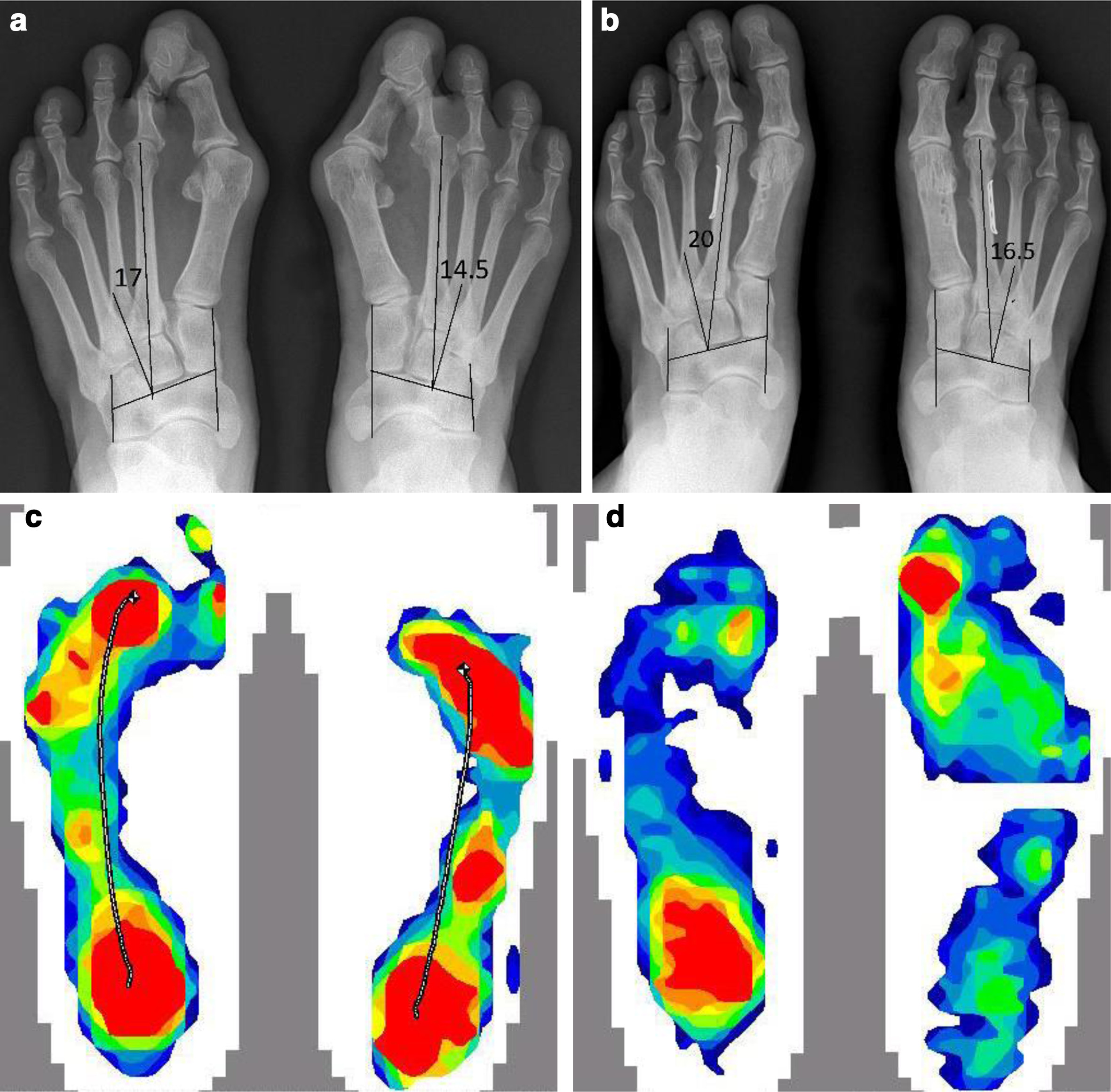 Fig. 4 
          a) Preoperative standing radiograph of a 55-year-old femalewith bilateral severe hallux valgus deformity Sgarlato’s metatarsus adductus angle (SMAA) 17° and 14.5°, intermetatarsal angle (IMA) 17.8° and 19.3°, and metatarsophalangeal angle (MPA) 35.6° and 48.1° of her left and right foot respectively. There was also overlapping toes with both second metatarsophalangeal joint (MPJ) dorsally subluxated. b) Her two-year postoperative standing radiograph showed the SMAA was 20° and 16.5°, IMA 7.2°and 6.3°, and MPA 19.9° and 13.7° of her left and right foot respectively. Both overlapping toes deformity and subluxated second MPJs were reduced and maintained. Preoperative metatarsosesamoid dissociation was also much improved. Both metatarsophalangeal joints and metatarsocuneiform joints’ congruences were improved. There was increased 2-3 intermetatarsal space from Figure 4a. c) Her preoperative pedobarographic study by F-scan revealed that most plantar force concentrated under midmetatarsal heads (red) during walking instead of the first ray (first metatarsal head and hallux) of normal feet. d) Her two-year postoperative pedobarographic F-scan revealed reduced mid metatarsal pressure bearing and increased first ray function.
          
        