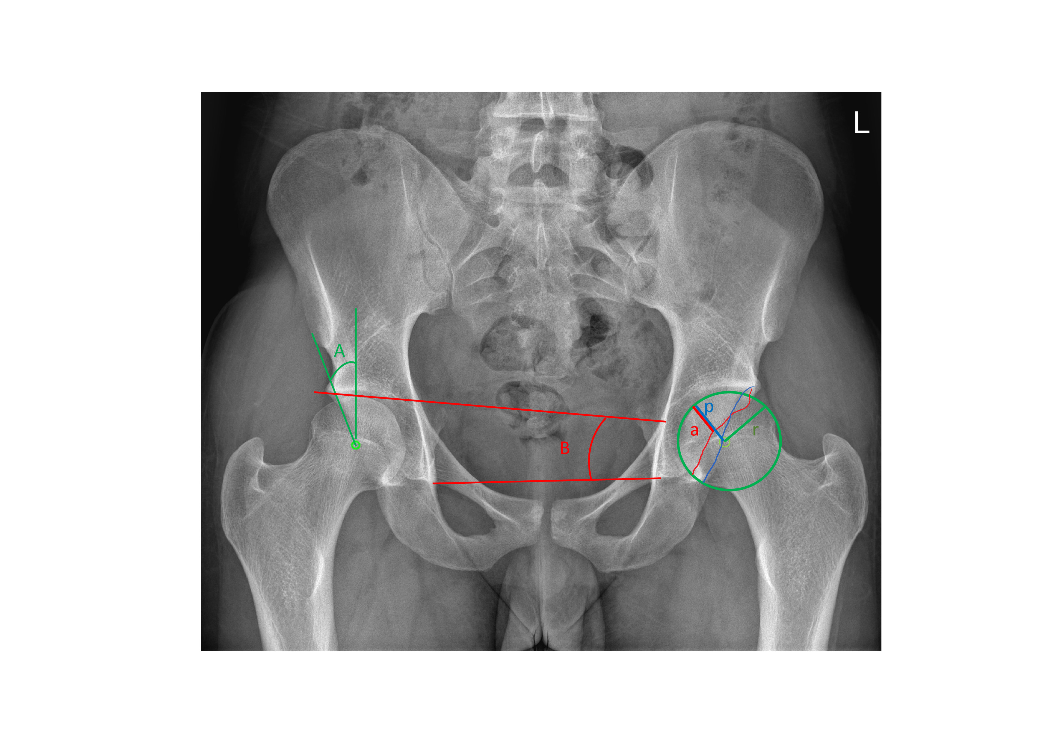 Fig. 1 
            Anonymized anteroposterior pelvic radiograph showing lateral centre-edge angle (A), acetabular index (B), anterior wall index (a/r), and posterior wall index (p/r).
          