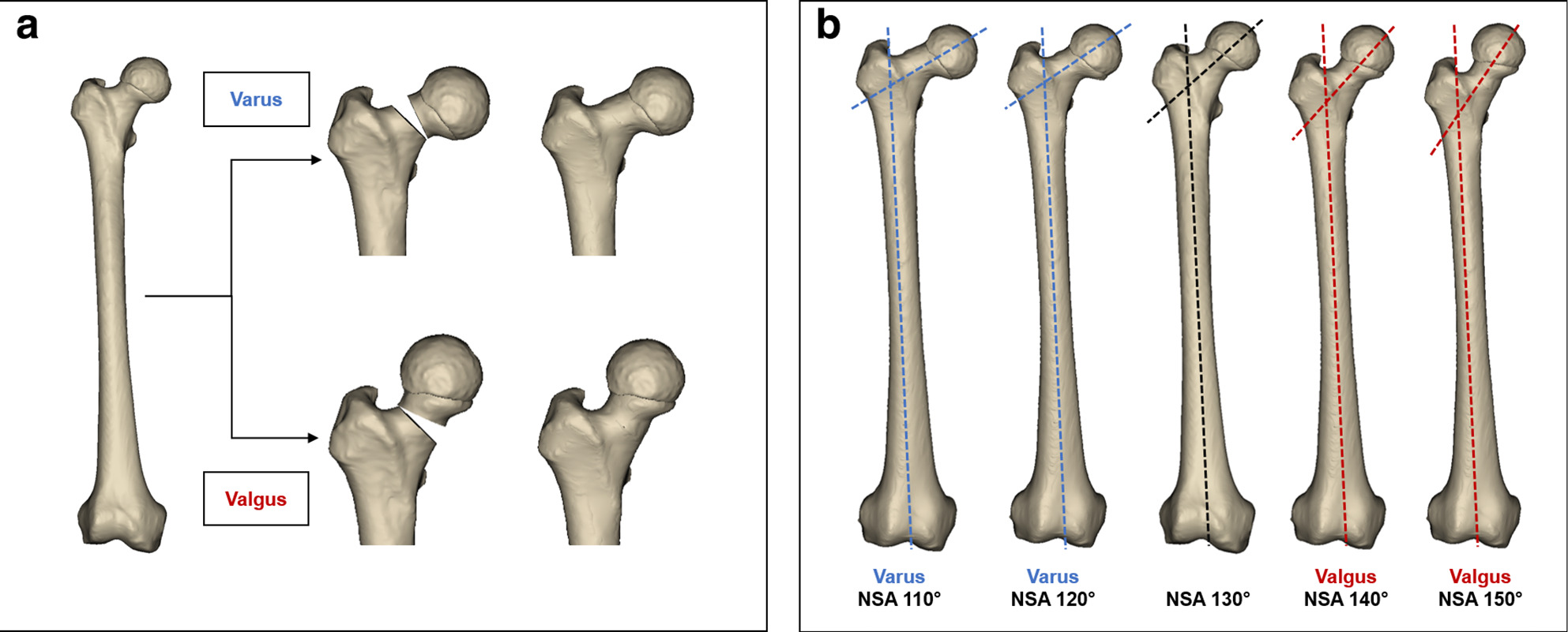 Fig. 2 
            a) 3D CT models of three patients (retroversion/normal version/anteversion) were manipulated to b) simulate different degrees of neck-shaft angle (NSA).
          