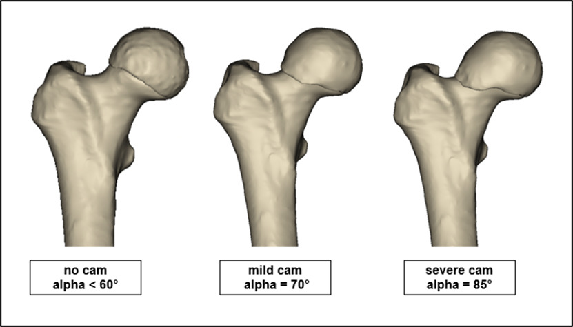 Fig. 3 
            3D CT models of three patients (retroversion/normal version/anteversion) were manipulated to simulate different α angles (no cam/mild cam/severe cam).
          