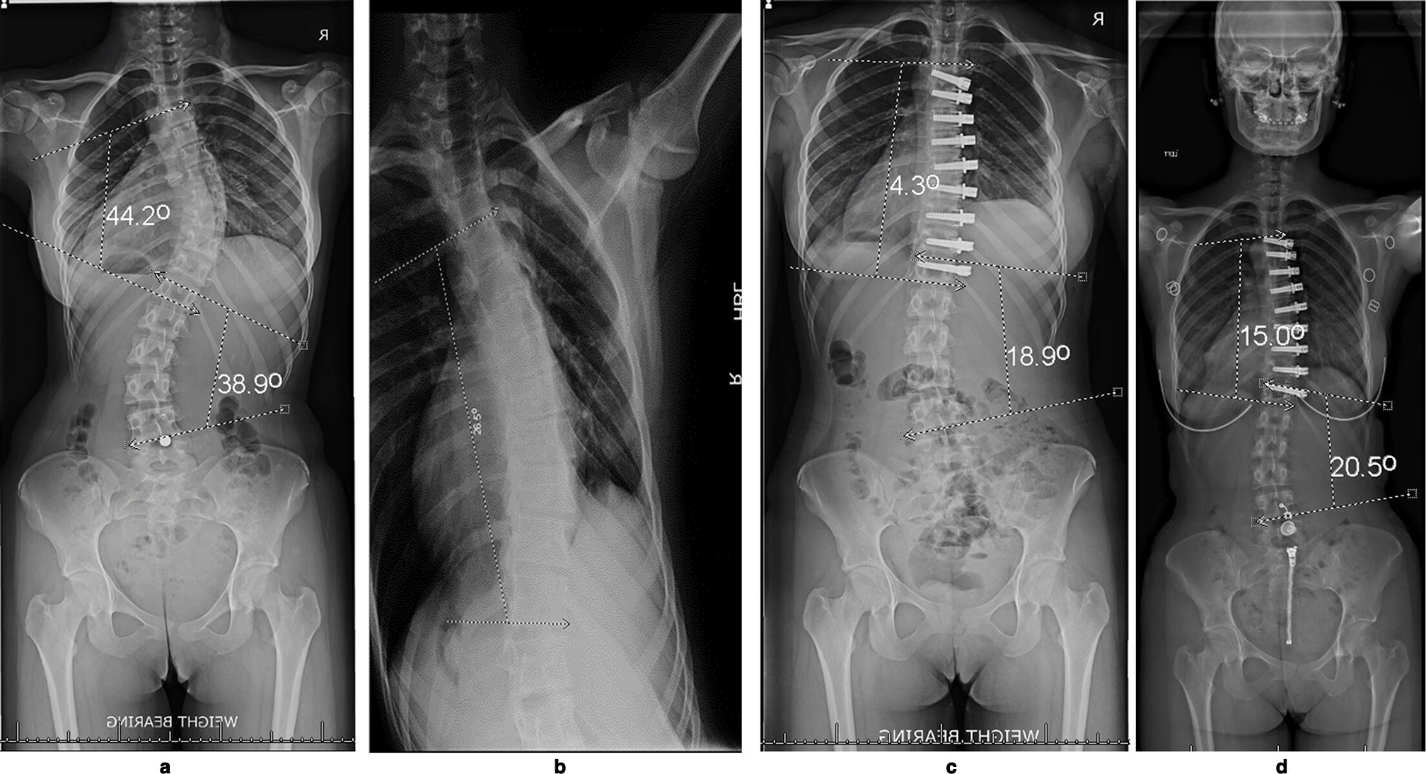 Fig. 4 
          This 14-year-old female patient was in the Group Risser Grade 3 to 5 vertebral body tethering anterior scoliosis correction. a) The main thoracic (MT) Cobb angle was 44.2° and thoracolumbar Cobb angle was 38.9°. She is categorized as Risser 4 and the tri-radiate cartilages are closed. b) The bending radiograph shows an unbend Cobb of 26.5° c) Six weeks postoperatively the MT Cobb angle of was 4.3° and the thoracolumbar (TL) Cobb angle was 18.9°. Note that this is better than the unbend Cobb angle on bending radiograph. d) Radiographs five years postoperatively show maintained improvement, but there is some stress relaxation with the Cobb angles, with the MT 15° and the TL 20.5°.
        