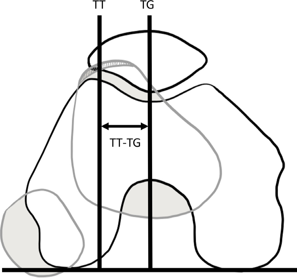 Fig. 1 
            Illustration of tibial tuberosity-trochlear groove measurement.
          