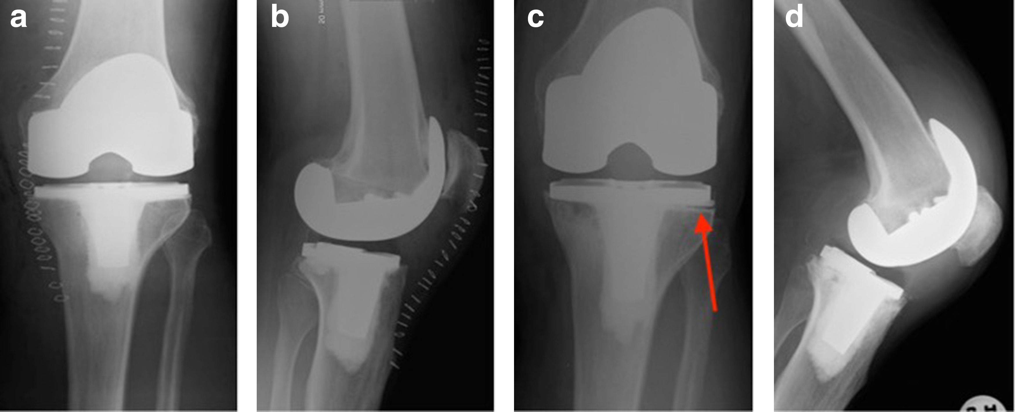 Fig. 2 
            Day one postoperative a) anteroposterior (AP), and b) lateral images of NexGen total knee arthroplasty (TKA); pre-revision c) AP, and d) lateral images of same TKA.
          