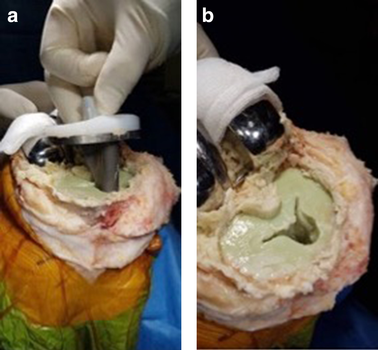 Fig. 3 
            Intraoperative images of the removal of the tibial baseplate with an intact cement mantle remaining.
          